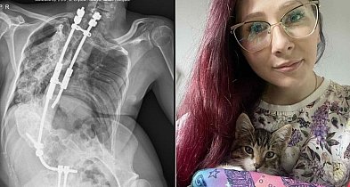 14 operacji to za mało – teraz życie Zuzanny wyceniono na 300 tysięcy złotych!-366945